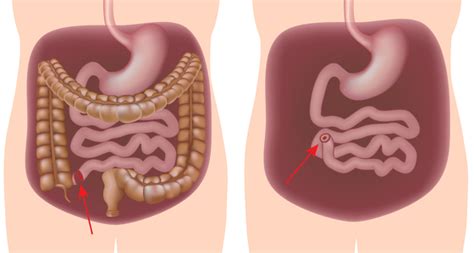 Pan-proctocolectomy with ileostomy surgery | IBDrelief