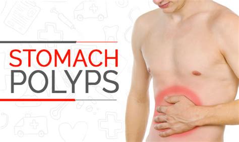 Stomach polyps - The Wellness Corner