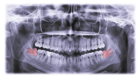 Abnormal Teeth Eruption - What to Expect From Diagnosis to Treatment