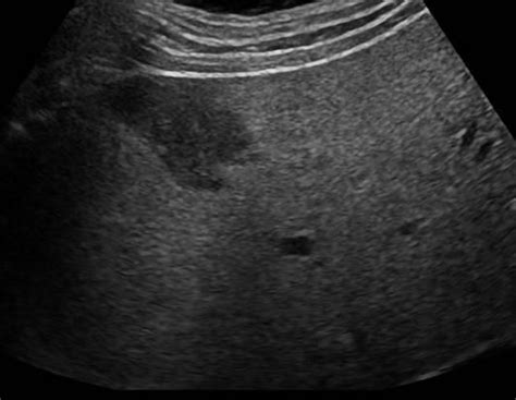 Abdomen and retroperitoneum | 1.1 Liver : Case 1.1.11 Fatty liver and focal sparing | Ultrasound ...