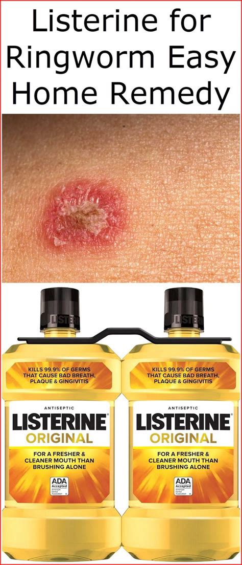 Listerine for Ringworm Easy Home Remedy | Listerine Foot Soak