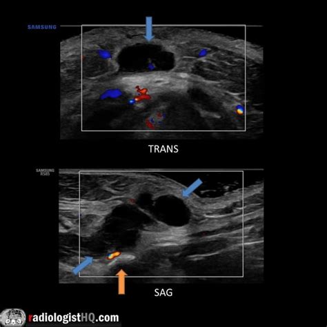 Ultrasound of infected thyroglossal duct cyst (blue arrows) containing ...