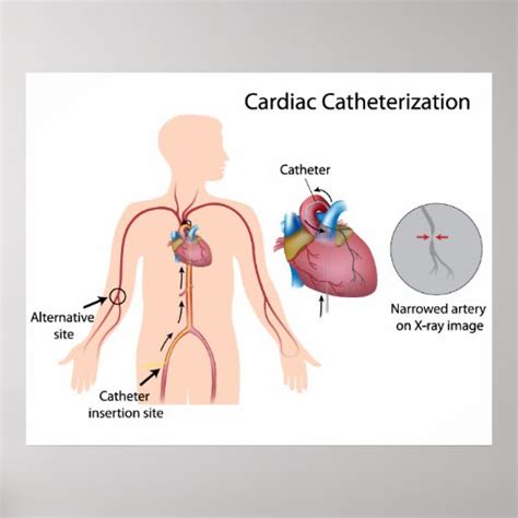 Cardiac catheterization Poster | Zazzle