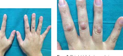 Figure 2 from Enlarging knuckle bumps. | Semantic Scholar