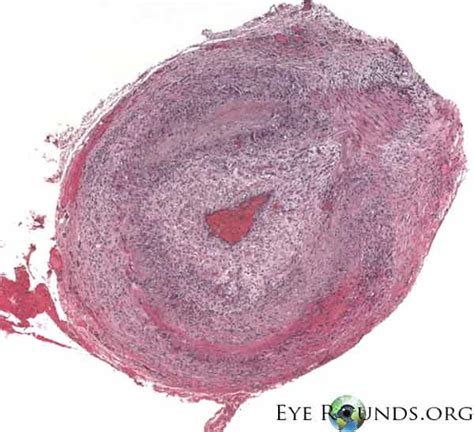 Atlas Entry - Giant cell arteritis