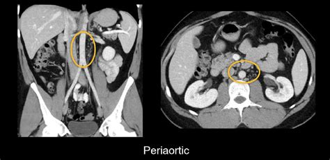 Abdominal CT: lymph nodes • LITFL • Radiology Library