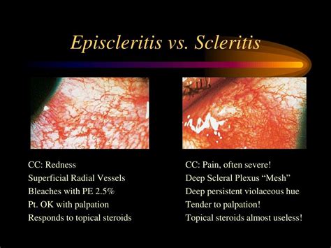 PPT - Scleritis Diagnosis & Management PowerPoint Presentation - ID:5542222