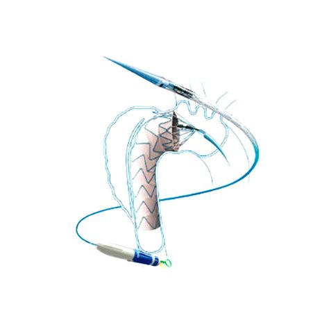 Durable Ascending Thoracic Aorta Stent Graft Sale or Rent Near Me – Goldstar Medical Equipment ...