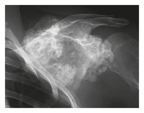 Anteroposterior radiographs of the left shoulder (a) 8 years before the ...