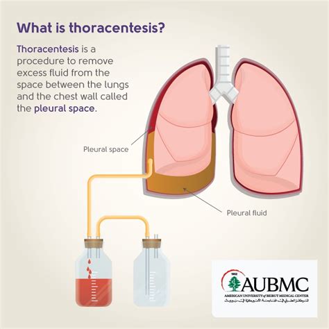 Thoracentesis Procedure