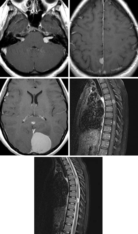 Vestibular Schwannoma | The Neurosurgical Atlas