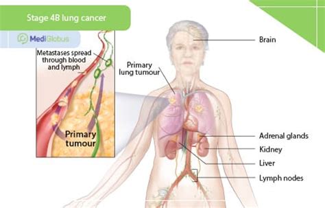 Can stage 4 lung cancer be cured? | Medical Tourism with MediGlobus ...