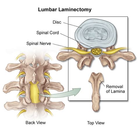 High-Quality Lumbar Laminectomy Surgery Cost In India-Medicare Spots