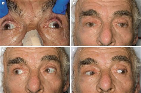 Wall-Eyed Bilateral Internuclear Ophthalmoplegia After Ruptured Aneurysm | Cerebrovascular ...