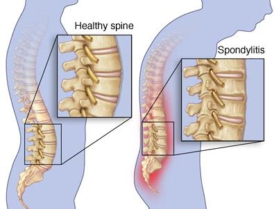 Ankylosing Spondylitis - Symptoms, Causes, Pictures, Treatment, Risk ...