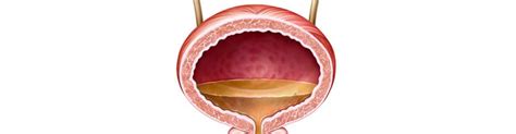 Vejiga Urinaria Inflamada - Síntomas, con infección y sin infección | Clínica Urológica Dr ...