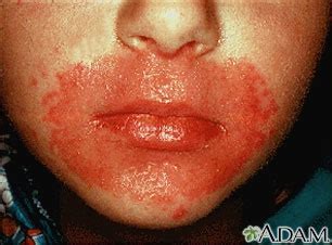 Candida infection of the skin | UF Health, University of Florida Health