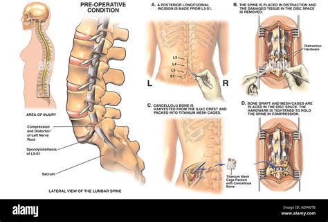 Lumbar Spine Surgery - L5 S1 Spondylolisthesis Stock Photo: 7712266 - Alamy