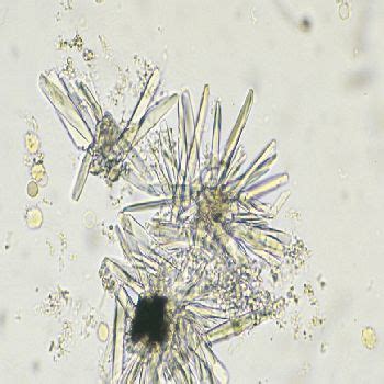 Calcium phosphate crystals in urine | Medical Laboratories