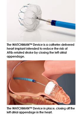 WATCHMAN™ Left Atrial Appendage Closure (LAAC) Device | Cooper University Health Care