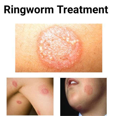 Best Medications For Ringworm Treatment - Public Health