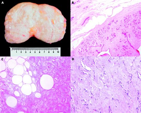 Hamartoma of the breast: a clinicopathological review | Journal of Clinical Pathology