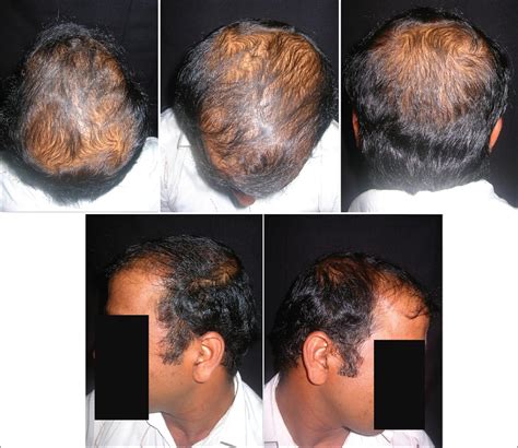 Top more than 64 androgenic hair loss - in.eteachers