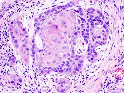 File:Oral cancer (1) squamous cell carcinoma histopathology.jpg - Wikimedia Commons