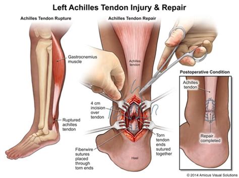 Achilles Tears Singapore Treatment | Foot and Ankle Specialist