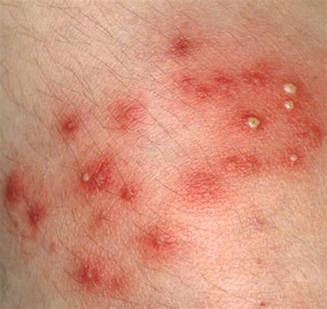 Staph Infection - Pictures, Contagious, Symptoms, Treatment, Causes ...