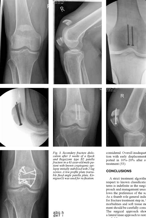 [PDF] Patellar fractures--a review of classification, genesis and evaluation of treatment ...