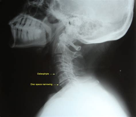 Cervical Spondylosis X Ray / Treatment for Cervical Spondylosis ...