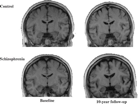 Figure 1 from A review of MRI studies of progressive brain changes in schizophrenia. | Semantic ...