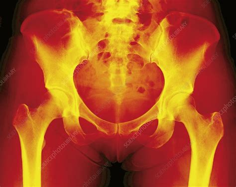 Normal female pelvis, X-ray - Stock Image F001/2986 - Science Photo Library