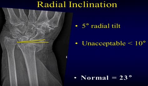 Distal Radius Fractures: What to look for on X-rays ...