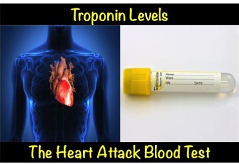 Troponin Levels – The Heart Attack Blood Test myheart.net