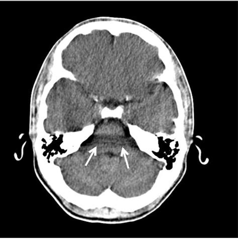 Beam Hardening Artifact In Ct Scan - The Best Picture Of Beam