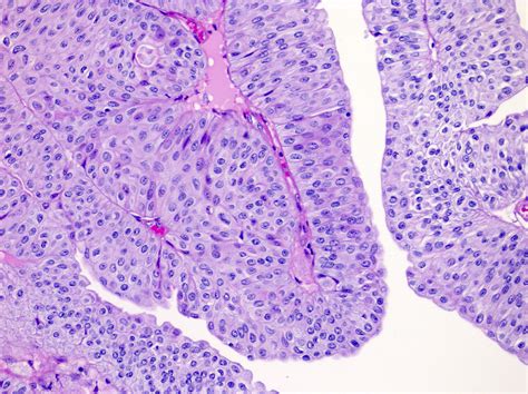 Urothelial Carcinoma Pathology Outlines