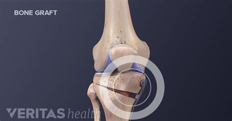 Knee Osteotomy Surgery Procedure