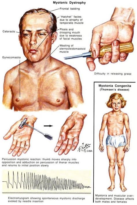 Myotonic dystrophy – learn all about it in 5 minutes – Costamedic