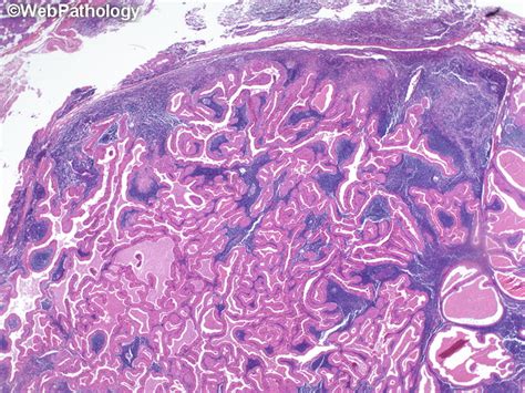 Webpathology.com: A Collection of Surgical Pathology Images