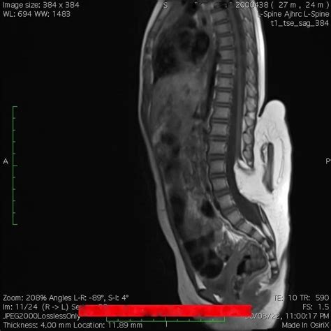 MRI image of the spinal cord showing closed spinal dysraphism with... | Download Scientific Diagram