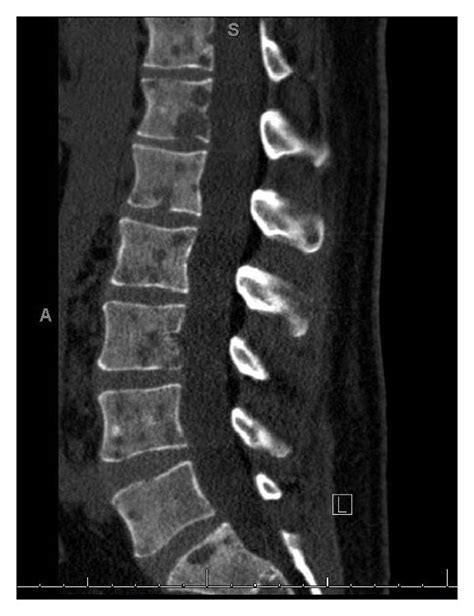 White Spots On Mri Lumbar Spine