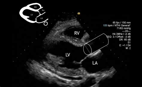 Cardiac Output by Echo - INTENSIVE