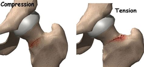 Running with Hip Pain - Femoral Neck Stress Fractures — The Physio Lab