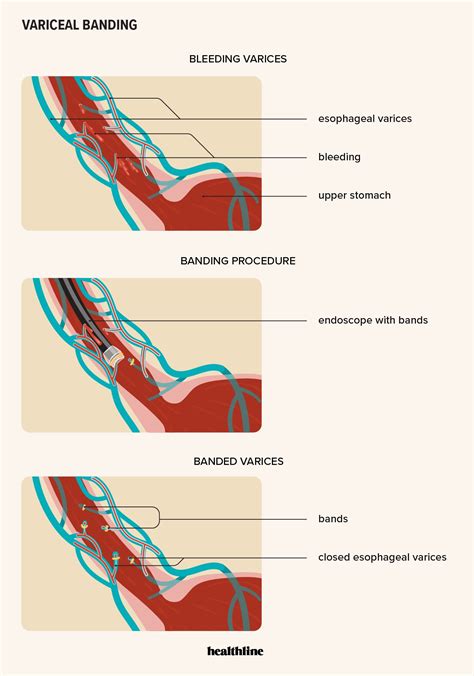 Esophageal Varices Banding