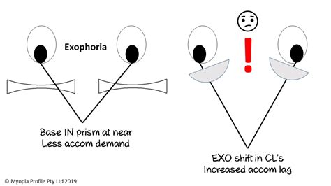 無料ダウンロード intermittent exotropia causes 341895-Causes of intermittent exotropia - Apictnyohbchh