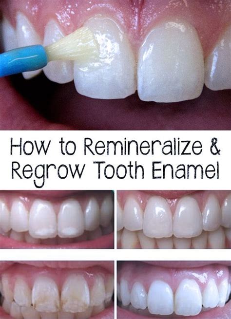 What Removes Enamel From Teeth at Ethel Houghtaling blog