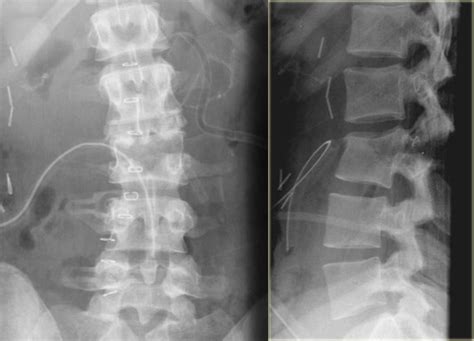 Lumbosacral Apl X Ray / Lumbar Spine Flexion And Extension Views Radiology Reference Article ...