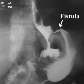 Upper gastrointestinal contrast study showing a gastrogastric fistula ...